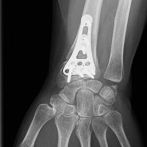 fracture-radius-distal-2