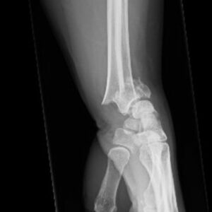 fracture-radius-distal