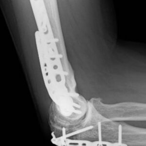 osteotomie-coude-2