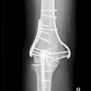 osteotomie-coude-3