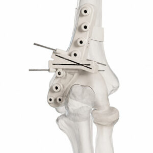 osteotomie-coude-4