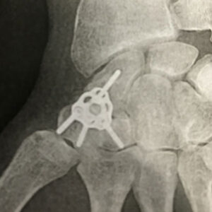 arthrose-scapho-trapezo-trapeziodienne